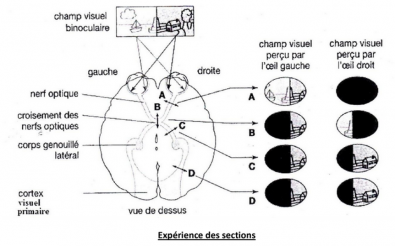 champ visuel temporal gauche