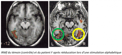 Resultats_cliniques_apres_reeducation.PNG