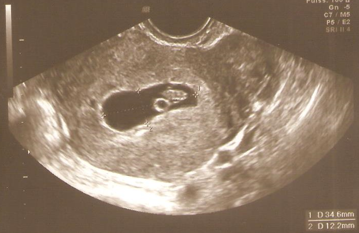 Echographie en début de grossesse
